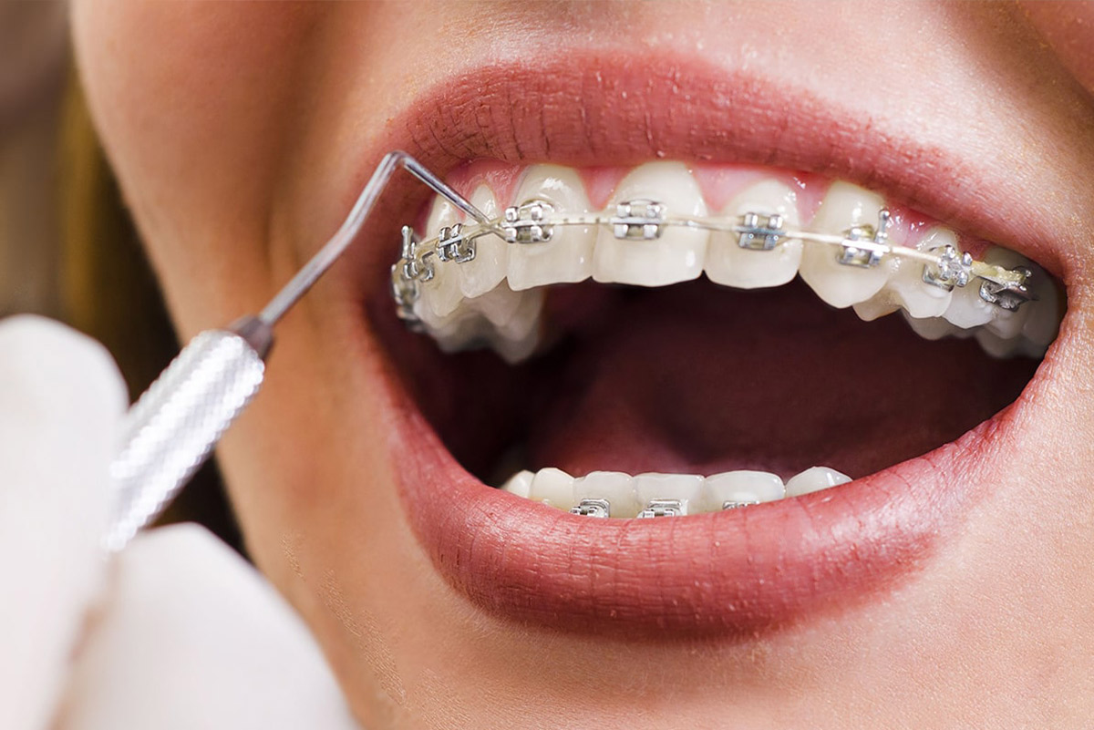 Les gouttières d'alignement , un traitement orthodontique